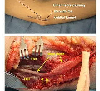 Nuovo Podcast - Sindrome del Tunnel Cubitale